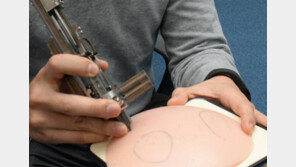 쉽고 싸진 모발이식… 2000개 2시간이면 끝