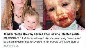 ‘뽀뽀’ 때문에 심각한 바이러스 질환 얻은 세 살배기 여아…무슨 일?