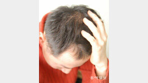 탈모 진행땐 머리 자주 감아 두피 노폐물 제거부터