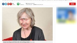 애완견에 얼굴 물어뜯긴 여성 “개가 내 인생 구했다”…왜?