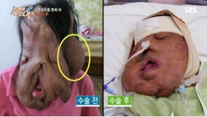 신경섬유종 심현희 씨, ‘혹 1kg 제거 성공’…근황 공개 