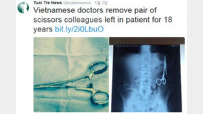 사람 배 속에 ‘가위’가 18년 간? 의사가 수술 후 ‘깜빡’