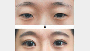 [헬스동아/헬스캡슐]이정자연미성형외과, 붙지 않는 뒤트임 수술법 개발 外