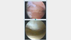 [헬스동아]손상된 무릎 관절에 줄기세포 이식… “12개월이면 완치 ”