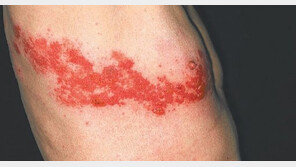 [헬스동아]부모님 노리는 대상포진… 이번 설엔 꼼꼼히 체크해 보세요