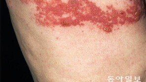 콕콕 찌르는 통증, 명절 후유증인줄 알았는데…