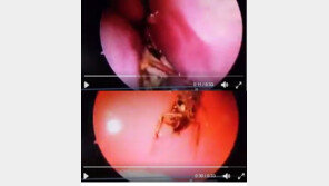 두통 호소 여성 두개골 안 살펴보니…산 바퀴벌레가 ‘꼼지락’