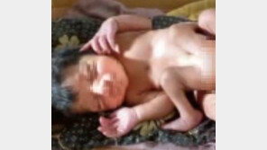 다리 넷· 생식기 둘 갖고 태어난 아기, 어떡해?