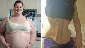 109kg 감량 20대 女, 복부·허벅지가 바람 빠진 풍선처럼 ‘쪼글쪼글’