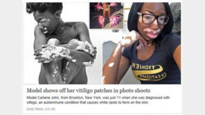 “소·달마시안” 놀림 받던 ‘백반증’ 여성 모델 데뷔, 어떻게?