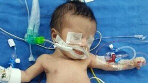 팔다리 8개로 태어난 아기, 수술 성공적…“세계적 희귀사례”