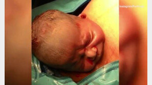 [영상]스스로 배 밖으로 나오는 아기…‘젠틀 제왕절개’ SNS 화제