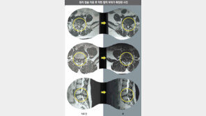 [헬스동아]척추관협착증… 허리디스크… 수술않고 국소마취로 시술