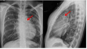 국내 의료진, 국산 기술로 만든 인공심장 판막 이식 임상시험 성공