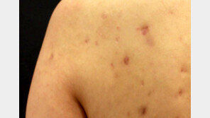 몸 드러나는 여름… ‘몸드름’ 때문에 민망해요