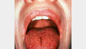 입 마르고 눈 뻑뻑… ‘쇠그렌 증후군’ 아세요