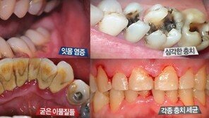  30초만에 입 속 찌꺼기 제거로 입냄새 싹~
