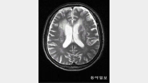 한국인 뇌구조-유전자 특성 파악… 전국민 조기진단 가능