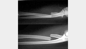 손흥민 부상, 생각보다 심각 “8∼12주 치료” 