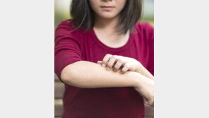 “도시에 사는 비만 여성, 아토피 피부염 재발 위험 높다”