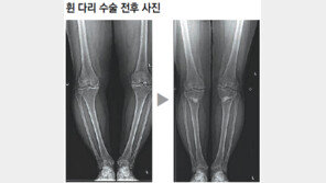 [헬스동아]닳고 닳은 내 무릎 연골이 살아났어요