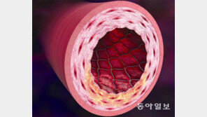 ‘급성 관상동맥증후군’ 10명중 1명은 재발… 사후관리가 중요
