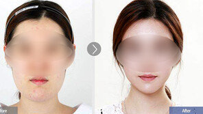 성형수술후 사진 과장한 병원에 과징금 1억