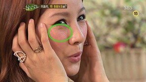 이효리 눈가에 오돌토돌 ‘비립종’ 눈길…비립종이 뭐기에?