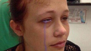 “보라색 눈물이…” 안구 문신으로 시력 이상 캐나다 모델