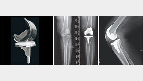 [헬스동아]나이 들수록 심해지는 무릎 통증… 인공관절 수술로 ‘걱정 끝’