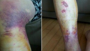 피멍에 피부 찢기고 파여…부산대병원 교수 폭행에 “조폭인가?” “의사가 사람잡아” 분노 