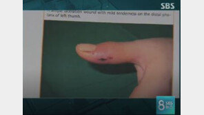 “개에 물려 ‘녹농균’ 감염? 세계적으로 6건 불과” 최시원 프렌치 불독 사건 반전 