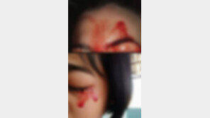 땀구멍에서 붉은 피가…1000만명 중 1명 희귀질환 21세 女, 왜?