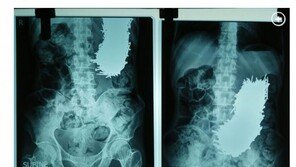 극심한 복통 호소한 男, X레이 찍으니 뾰족한 쇠못 600여 개가…