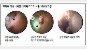 [헬스동아]MRI도 못 찾는 허리 통증 잡는다… 꼬리뼈 내시경 레이저 ‘눈길’