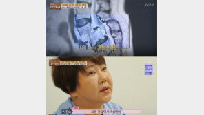 가수 이은하, 외모 달라진 이유가…척추분리증·쿠싱증후군, 무슨 질환이길래? 