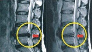 [헬스동아]국소마취 후 15분이면 OK… ‘하이브리드 고주파 디스크 시술’