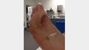 ‘아쉬운 기권패’ 정현, 발바닥 사진 보니…“진통제 안 들을만해”