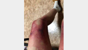 영하 40℃에 ‘미니스커트’  외출 여대생, 동상 입어 병원행