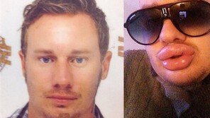 메릴린 먼로 닮고 싶어 미용시술 받은 男, 전·후 사진 ‘어머나’ 