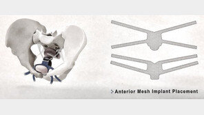 [헬스동아]아래로 빠져 걷기 불편한 ‘방광탈출증’ 인조 그물망으로 간단하게 교정한다