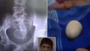 사람 몸에서 알이 쑥쑥? 14세 소년 주장에 의사들 “말이 안 되는데…” 당혹