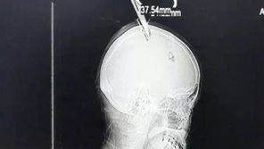머리에 가위 꽂힌 채 홀로 버스타고 병원행…현실의 원더우먼?