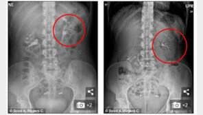 “뱃속에서 공 구르는 느낌” 엑스레이 찍어보니… 신장이 ‘오르락내리락’