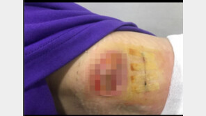 “오늘 찍었다, 마음 무너져”…한예슬, 지방종 제거부위 추가 사진 공개