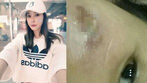 ‘미나 동생’ 니키타 “2년 전 의료사고로 얼굴 화상…한예슬 보고 용기” 사진 공개