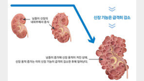 말기 신부전 부르는 ‘다낭성신장병’… 가족력 의심되면 유전자검사 꼭 받으세요