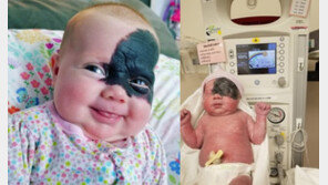 왼쪽 눈 주변 뒤덮은 검은 ‘반점’ 가지고 태어난 여아…“리틀 배트맨”