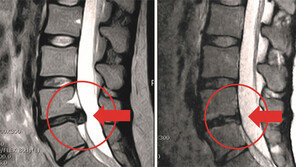 “디스크, 하이브리드 고주파 시술로 근본부터 잡는다”