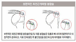 회전근개파열 치료난제 ‘마지막 퍼즐’ 찾은 ‘어깨’ 전문의들